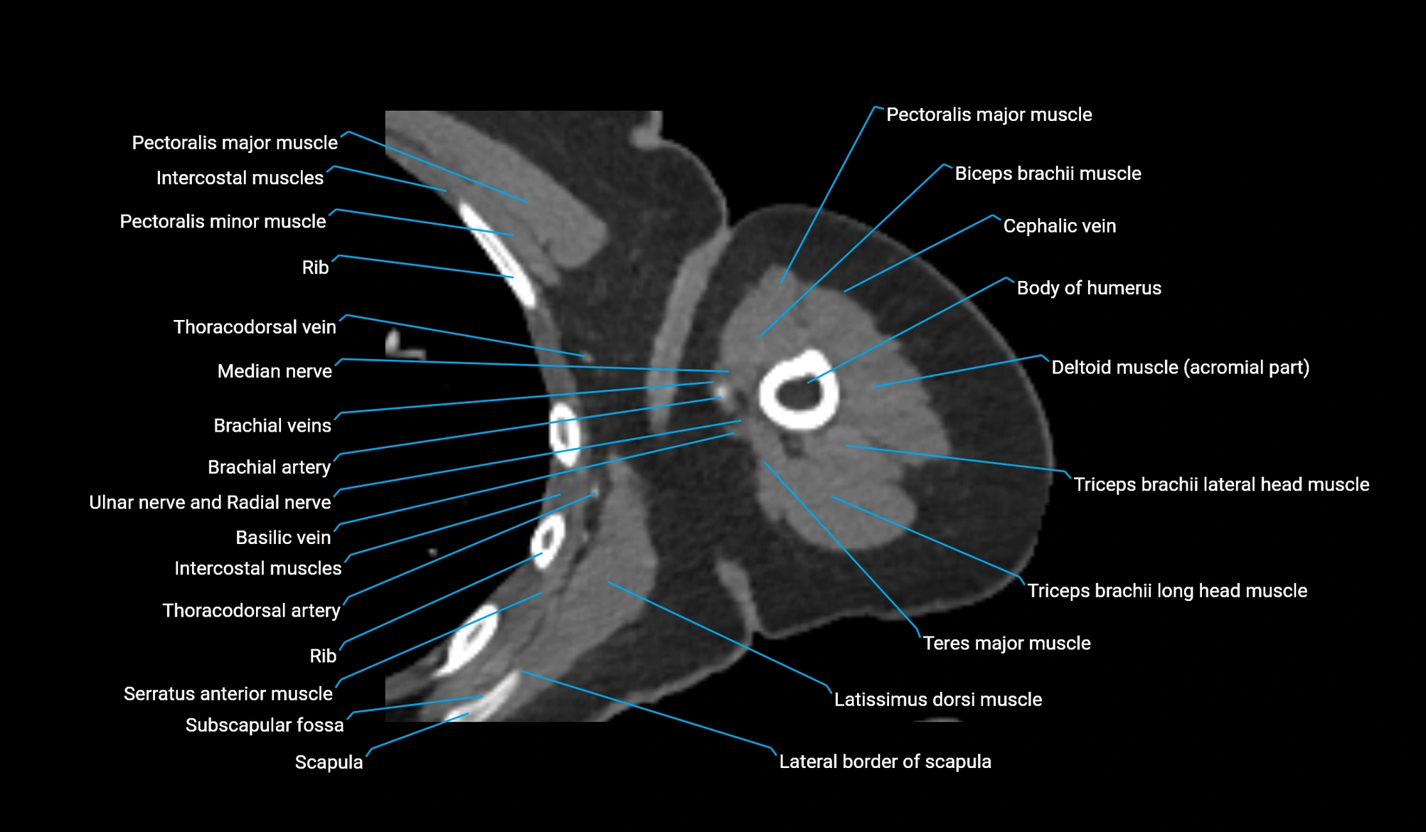 CT upper arm axial  cross sectional anatomy labelled radiology image -00172.webp